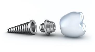 Pieces of a dental implant in Eagan, MN