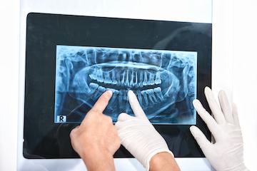 Dentist in Eagan MN pointing at digital x-ray