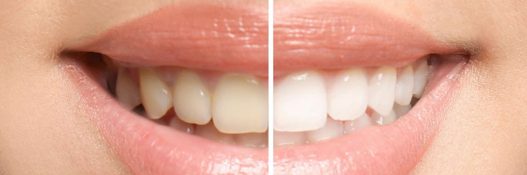 Before and after teeth whitening of teeth with dental implants in Eager MN