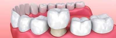 Dental Crown in Eagan, MN | Wood Park Dental