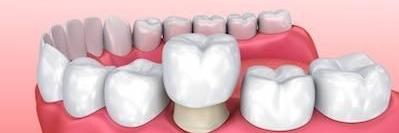 Digital graphic of CEREC dental crown covering tooth in Eagan, MN