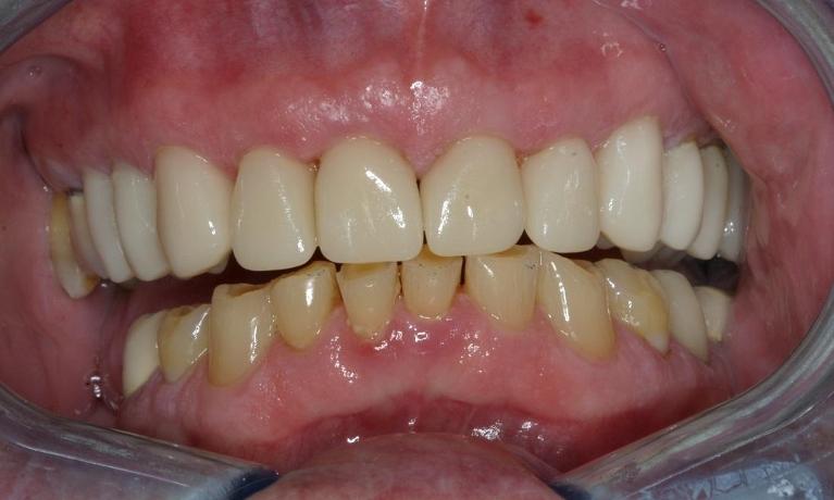 CEREC-Porcelain-Crowns-After-Image