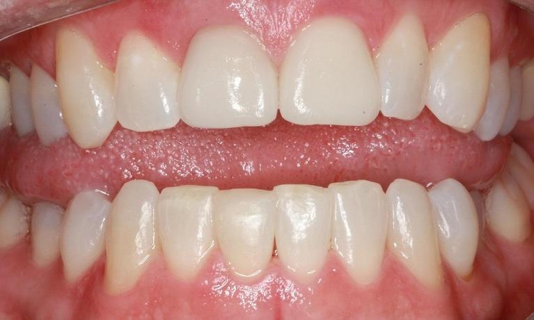Full-Smile-Makeover-Clear-Braces-Crowns-Whitening-Fillings-After-Image