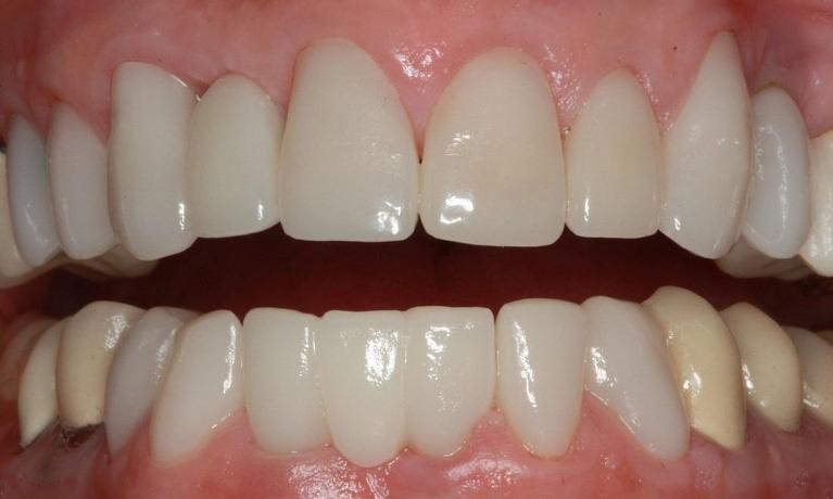 Close up of dental patients teeth after dental crowns in Eagan, MN