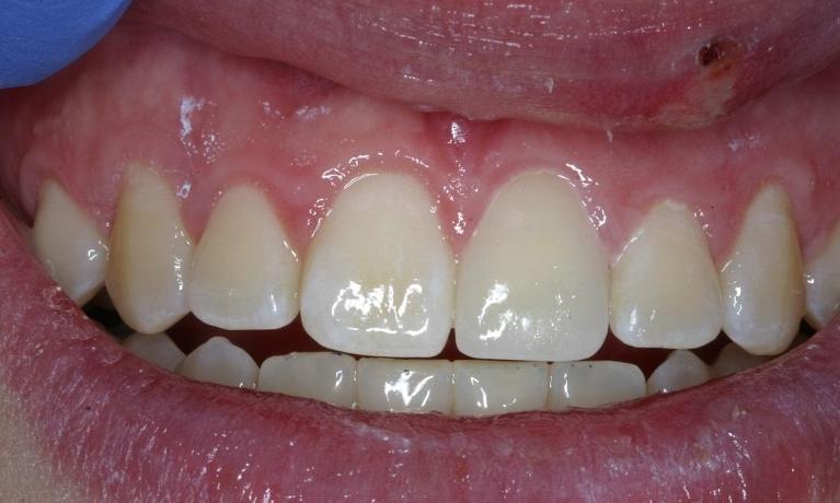 Same-Day-Porcelain-Crown-After-Image