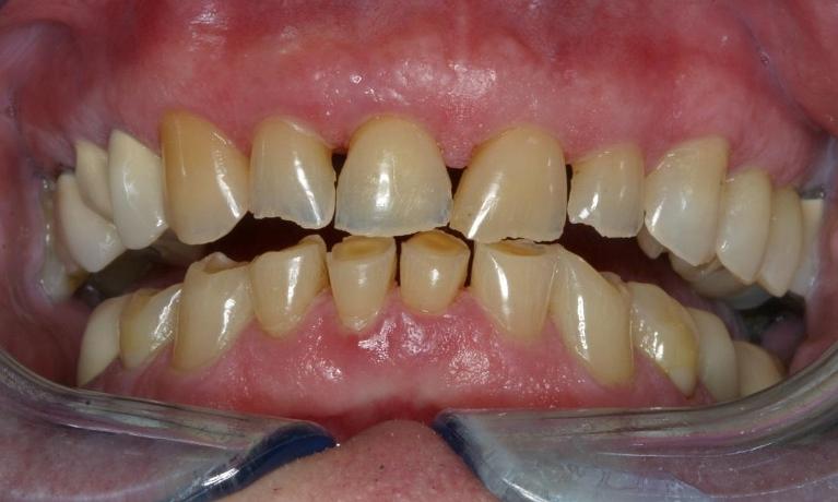 CEREC-Porcelain-Crowns-Before-Image