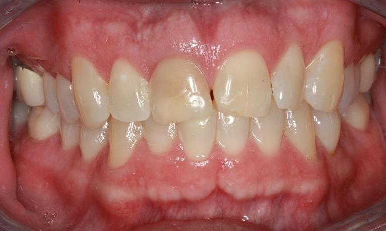 Full-Smile-Makeover-Clear-Braces-Crowns-Whitening-Fillings-Before-Image