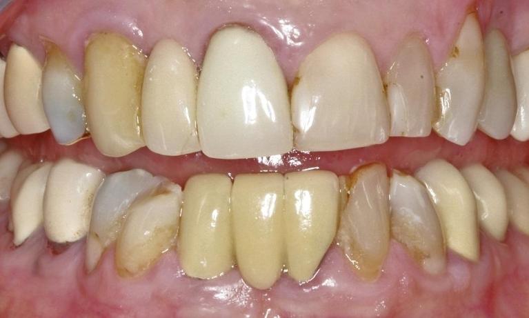 Stained and crooked teeth before dental crowns in Eagan, MN