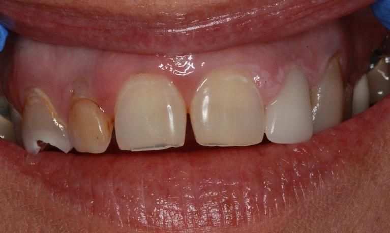 Close up of teeth before dental crowns and bridges in Eagan, MN