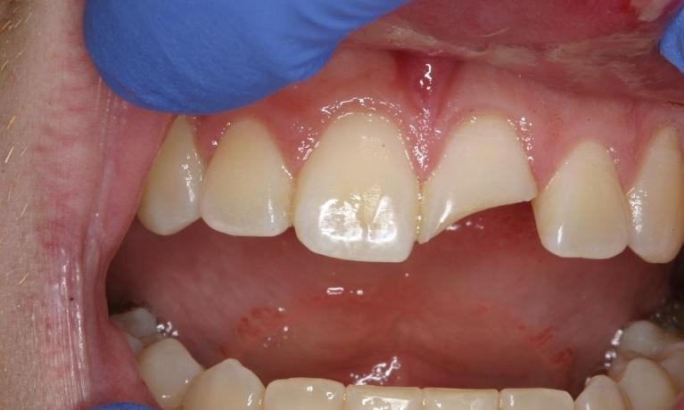 Same-Day-Porcelain-Crown-Before-Image